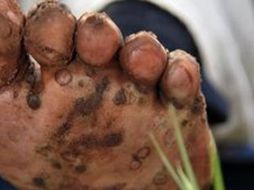 Generalmente, la enfermedad entra por los pies. AP  /