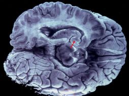 La teoría formal es que un mecanismo tóxico de la neurona causa que la proteína Tau fosforilada dañe la neurona y cause su muerte. EFE  /