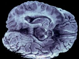 Basaron investigación en 115 estudios que investigaron percepción del habla con imágenes de resonancia magnética o tomografías. EFE  /