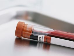 La fibrilación auricular forma coágulos que pueden desplazarse hasta el cerebro y causar un evento vascular cerebral. ESPECIAL ID  /