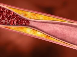La aterosclerosis consistente en el endurecimiento de las arterias y está asociada con diabetes, infartos e hipertensión. ESPECIAL ID  /