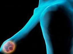 Más de tres mil 500 mujeres mueren al año en México debido al cáncer de mama. ESPECIAL ID  /