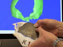 Los médicos reconstruirán la parte dañada del craneo de Malala con una placa de titanio. AP /