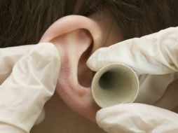 La otosclerosis es una enfermedad caracterizada por la pérdida progresiva de la audición. ARCHIVO /