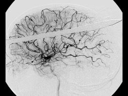 Este 29 de octubre se celebra el Día Mundial de la Enfermedad Vascular Cerebral, que va en aumento. ARCHIVO /