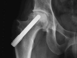 Señalan que algunas piezas importadas no siempre servían porque eran muy grandes para la talla de pacientes mexicanos. ARCHIVO /