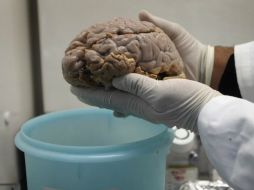 La reducción importante de la corteza cerebral se relaciona con una disminución significativa del coeficiente de inteligencia. ARCHIVO /