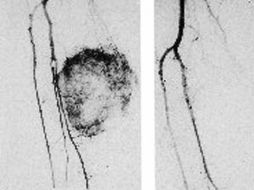 En México, los sarcomas de tejidos blandos se presentan en más de dos mil adultos cada año. ARCHIVO /