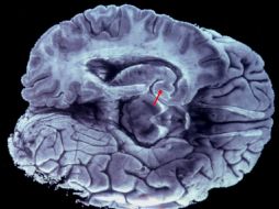 La EM es un mal del sistema nervioso central que afecta a más de 20 mil personas en México. ARCHIVO /