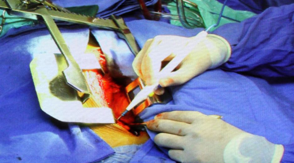 La fibrilación auricular es una enfermedad cardiaca, y al final es la causa de muerte cuando se presenta un infarto. NTX / ARCHIVO