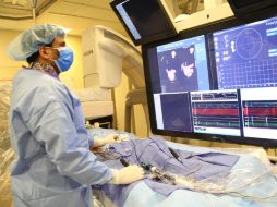 El nuevo marcapasos diminuto se asienta en el ventrículo derecho y no coordina los dos hemisferios cardíacos. AP / ESPECIAL