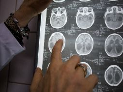 Incluso meses después pueden darse secuelas como cambios en la concentración y en la conducta. NTX / ARCHIVO