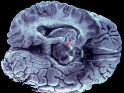 La terapia debe hacerse de forma constante en la cabeza del paciente a niveles muy bajos. EFE / ARCHIVO