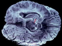 Se comprobó que cuanto más activa era la proteína es menor la esperanza de vida de los pacientes. EFE / ARCHIVO