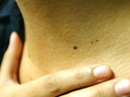 Afirman que el de piel es el cáncer más agresivo, incluso por encima de los de mama, próstata o pulmón. EL INFORMADOR / ARCHIVO