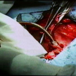 Hasta octubre, depurarán lista de espera de trasplantes