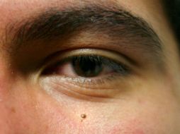 El melanoma se presenta cada vez más en los adultos jóvenes por debajo de los 40 años. EL INFORMADOR / ARCHIVO