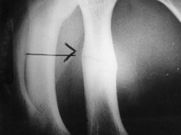 El consumo de vitamina D es fundamental para fijar el calcio a los huesos. EL INFORMADOR / ARCHIVO