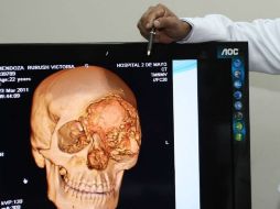 Los tumores son sistemas muy complejos, y su evolución depende del entorno tridimensional que las rodea. EFE / ARCHIVO