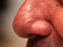 Para ayudar a prevenir futuros sangrados nasales, se debe mantener húmedo el revestimiento interior de la nariz. NTX / ARCHIVO