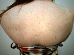 Entre los primeros signos de este padecimiento está la aparición de nuevos lunares, cambios de color, tamaño y forma de los existentes. EL INFORMADOR / ARCHIVO