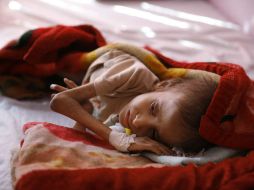 Un niño con síntomas de desnutrición yace en una cama en espera de tratamiento en un centro de alimentación terapéutica en Saná. AP /