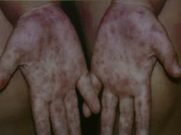 Autoridades realizan acciones coordinadas para evitar mayores contagios. NTX / ARCHIVO