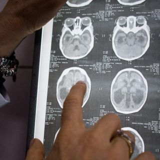 Virus del Zika se muestra efectivo contra tumor cerebral, según estudio