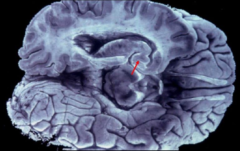 La prueba puede permitir la detección de este padecimiento hasta con 30 años de anticipación. EFE/Archivo