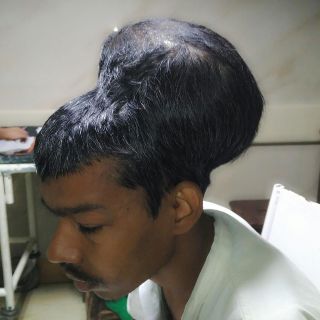 Fotogalería: Cirujanos extraen un tumor cerebral de 1.8 kilos