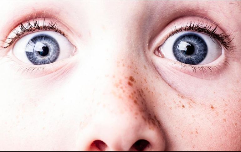 En algunas ocasiones las pecas pueden confundirse con lesiones en la piel llamadas lentigos malignos, los cuales son manchas grandes de color café oscuro o negro que deben ser atendidos por un especialista. ESPECIAL / Pixabay