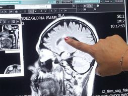 Aseguran que se debe tomar más en cuenta en caso de que el paciente tenga antecedentes familiares de esclerosis múltiple y curse de los 20 a los 40 años de edad. ESPECIAL / imss.gob.mx