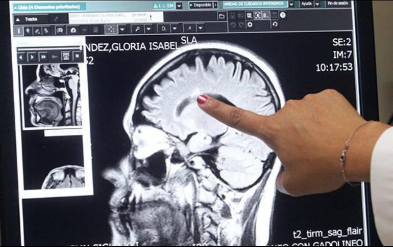 Aseguran que se debe tomar más en cuenta en caso de que el paciente tenga antecedentes familiares de esclerosis múltiple y curse de los 20 a los 40 años de edad. ESPECIAL / imss.gob.mx