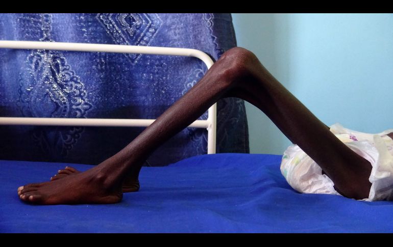 Abdelrahman Manhash, un niño de 5 años que sufre de desnutrición severa y pesa 5 kilos, se recuesta en una cama en una clínica en Khokha, Yemen. AFP