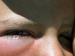 Los ojos y nariz tienen conexiones internas por lo que gripe puede causar conjuntivitis. EL INFORMADOR / ARCHIVO