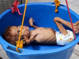 El conflicto armado en Yemen agrava la carencia de alimentos. Un niño yemení con malnutrición. AFP/ARCHIVO