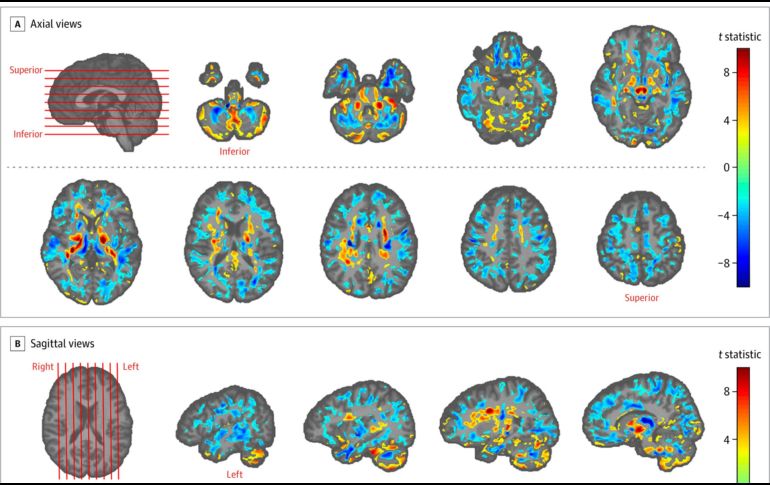 Una muestra de las diferencias entre las tomografías de los pacientes analizados. AP/American Medical Association.
