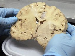 El Alzheimer si es detectado en la etapa inicial se puede retrasar su desarrollo con ejercitación del cerebro. NTX / ARCHIVO