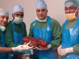 Un riñón normal pesa entre 120 y 150 gramos y mide unos 12 centímetros de longitud; el riñón extirpado medía 45 centímetros. TWITTER/@NewIndianXpress