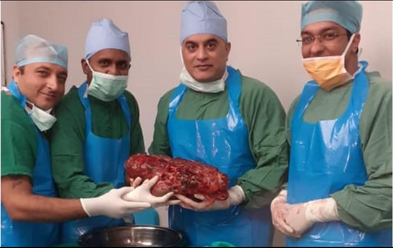 Un riñón normal pesa entre 120 y 150 gramos y mide unos 12 centímetros de longitud; el riñón extirpado medía 45 centímetros. TWITTER/@NewIndianXpress