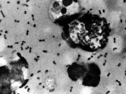 La peste bubónica se caracteriza por la inflamación de los ganglios linfáticos. GETTY IMAGES /