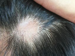 La caída del cabello causada por el coronavirus suele ser temporal. GETTY IMAGES