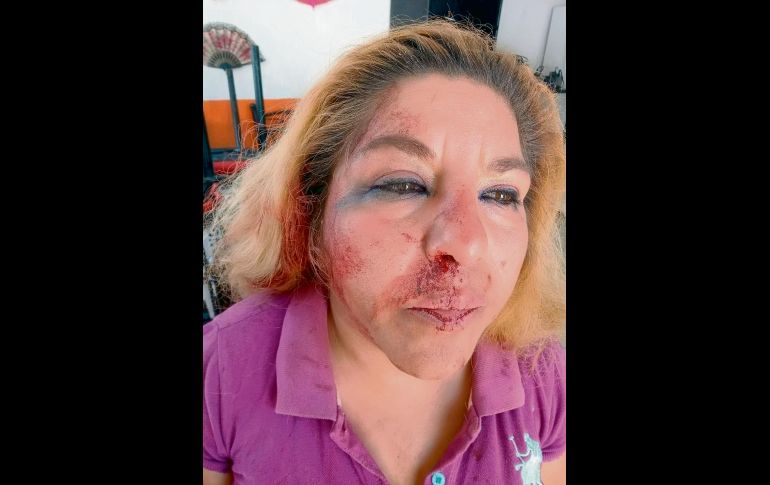 El parte médico, levantado en el Hospitalito, indica que Juana sufrió fractura de nariz, mordidas en diferentes partes del cuerpo y raspaduras. ESPECIAL