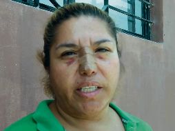 El parte médico, levantado en el Hospitalito, indica que Juana sufrió fractura de nariz, mordidas en diferentes partes del cuerpo y raspaduras. ESPECIAL