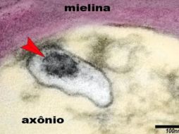La imagen muestra un axón de una neurona en el cerebro de un niño con síndrome inflamatorio multisistémico pediátrico (SIM-P). La flecha señala al virus SARS-CoV-2 en una vesícula en el citoplasma del axón. ELIA CALDINI