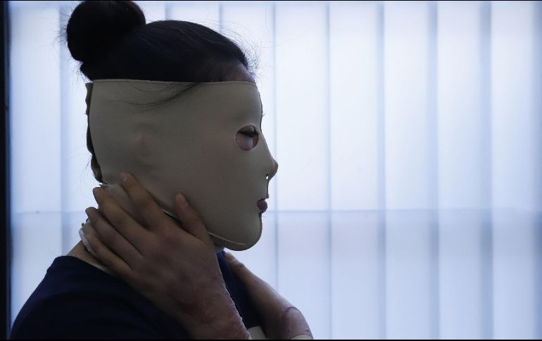 En México, 27 mujeres han sufrido ataques con ácido. Tan solo en 2021, seis víctimas denunciaron sus casos. SUN / ARCHIVO