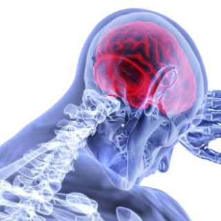 Señales de alerta para identificar un derrame cerebral