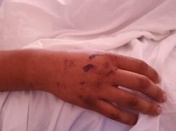 Giovanni Daniel, de 21 años, es una de las 26 personas lesionadas el sábado en el partido de Querétaro vs Atlas. En la imagen, su mano aún con heridas.  EL INFORMADOR/ E. GÓMEZ