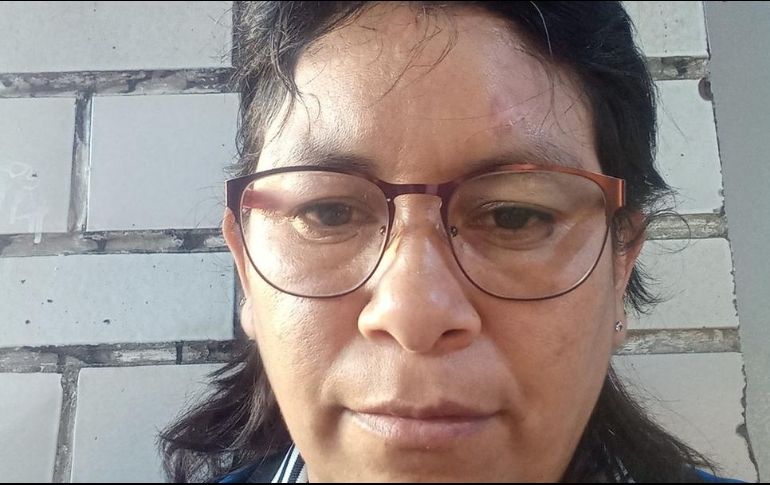 Marisol García Alcántara tiene, encima de su ceja izquierda, la cicatriz que le dejó la bala. CORTESÍA DE MARISOL GARCÍA ALCÁNTARA