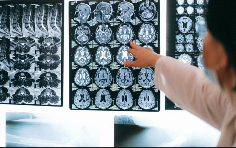 Investigadores proponen un nuevo modelo computacional relacionado con el Alzheimer. ESPECIAL/CORTESÍA MAYO CLINIC.